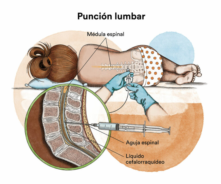 La Leucemia Linfobl stica Aguda En Adultos Fundaci n Carreras